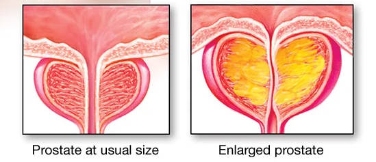 前列腺增生示例.jpg
